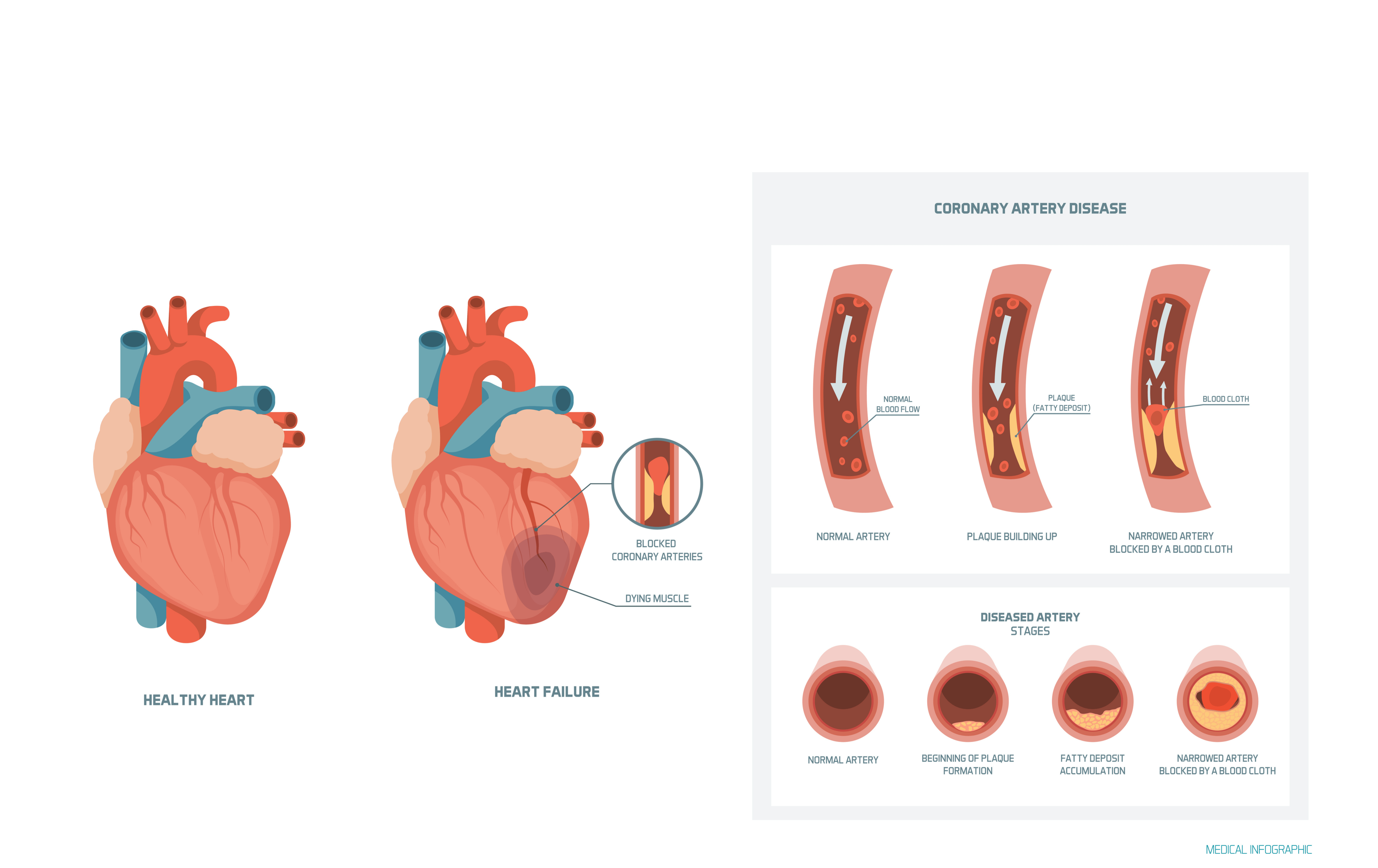 Explanation Of Coronary Heart Disease